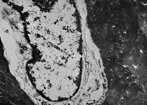 M,19y. | osteocyte - chondrosarcoma - jaw